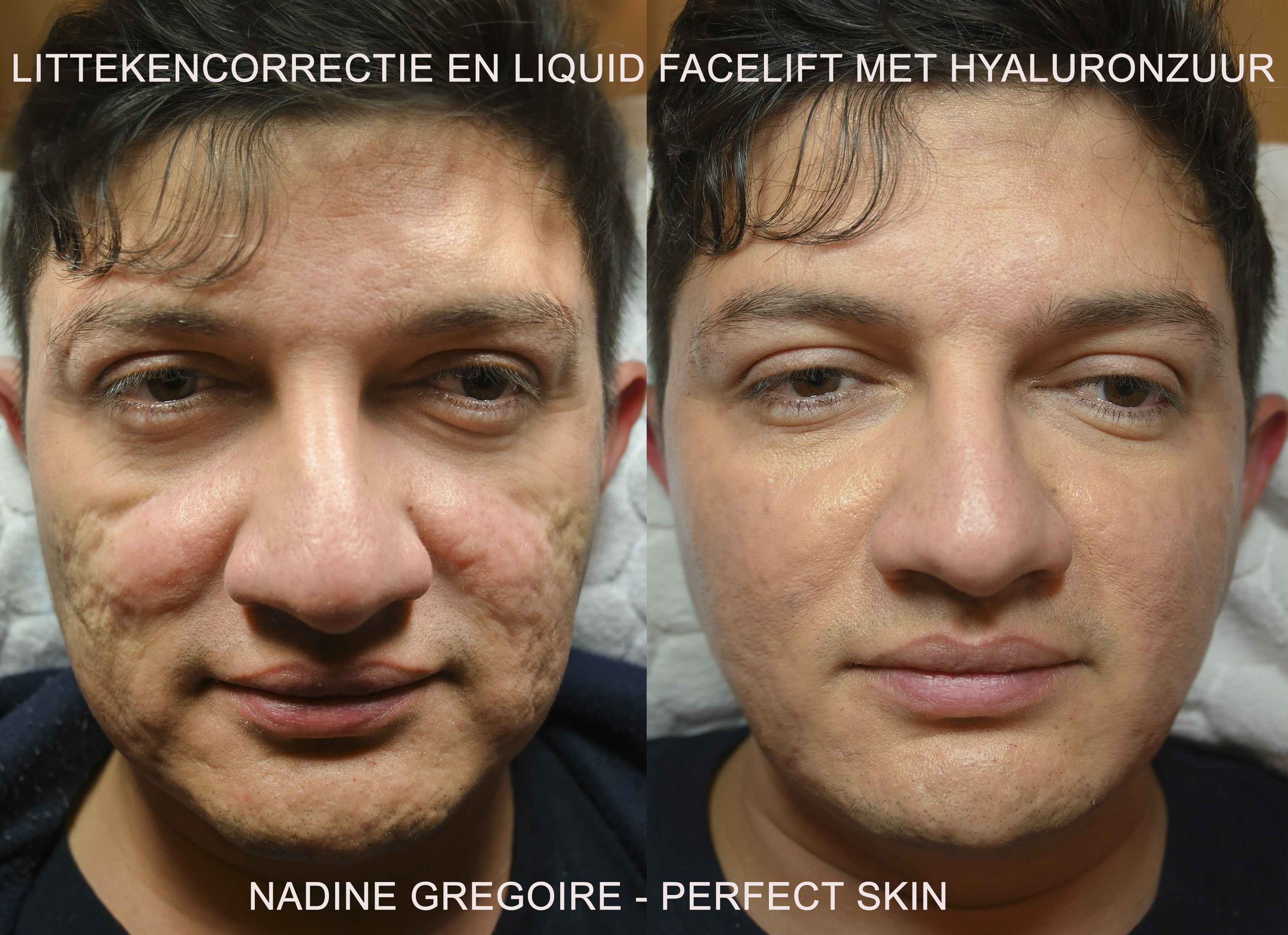 Hyaluronzuur is ideaal het verwijderen van acnelittekens in het gezicht.