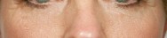 na foto van opvullen van traangootjes met hyaluronzuur (Teosyal Redensity 2) | ogen