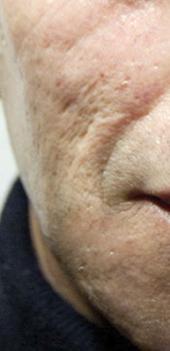 Voor foto van volumeherstel en verwijderen van littekens met hyaluronzuur | acné & littekens  