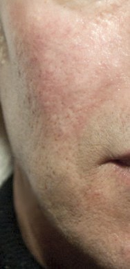 na foto van volumeherstel en verwijderen van littekens met hyaluronzuur | acné & littekens  