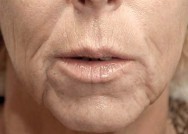 Voor foto van verwijderen  van rimpels en herstel van volume  met hyaluronzuur | lippen