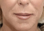 na foto van verwijderen  van rimpels en herstel van volume  met hyaluronzuur | lippen