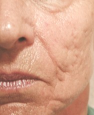 Voor foto van littekens- en rimpelcorrectie met hyaluronzuur | acné & littekens  