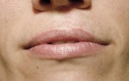 Voor foto van correctie schisis met hyaluronzuur | lippen