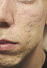Voor foto van littekens verwijderen van tengevolge van acne | acné & littekens  