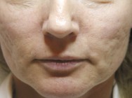 Voor foto van verwijderen van littekens  tengevolge van acne | acné & littekens  