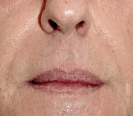 na foto van de correctie neuslippenplooi en boven- en onderliprimpels met hyaluronzuur | diepe neuslippenplooi aanpakken