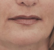 na  foto van de correctie mondhoeken en neuslippenplooi met hyaluronzuur | lippen