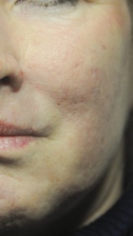 na foto van correctie van acne littekens met hyaluronzuur | acné & littekens  