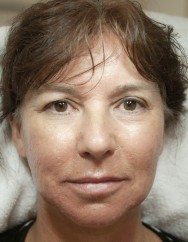 na  foto van de behandeling littekens verwijderen en liquid facelift met hyaluronzuur | acné & littekens  