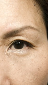 na foto van de behandeling van opvullen van traangootjes me hyaluronzuur (Teosyal Redensity 2) | traangootjes onder de ogen