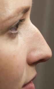 Voor de correctie van neus met hyaluronzuur | neus