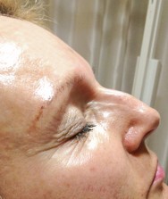 Voor foto correctie van neus met hyaluronzuur  | liquid facelift met beautiphication, de golden ratio