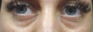 Voor traangootjes opvullen met hyaluronzuur  | ogen