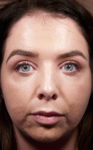 Voor foto van kleine acne littekencorrecties en liquid facelift van mondhoeken met hyaluronzuurbehandeling  | marionetlijnen/afhangende mondhoeken liften