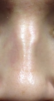 Voor foto van correctie van neus met hyaluronzuur  | neus
