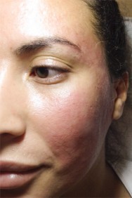 na DIRECT NA DE HYALURONZUUR BEHANDELING | acné & littekens  