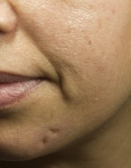 Voor foto van correctie van 2 littekens op kin met hyaluronzuur  | acné & littekens  