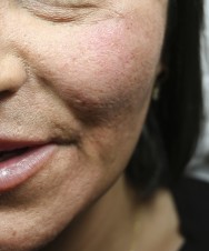 na Littekencorrectie met hyaluronzuur | acné & littekens  
