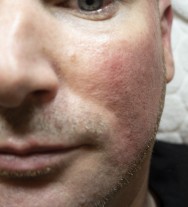 na Direct na de correctie van littekens met hyaluronzuur | acné & littekens  