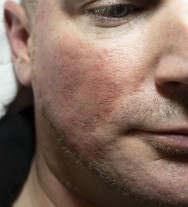 na Direct na de correctie van littekens met hyaluronzuur | acné & littekens  